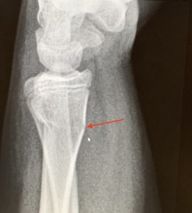 X-ray of broken arm
